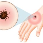 Kullancscsípésből halálos allergia: új kutatási eredmények